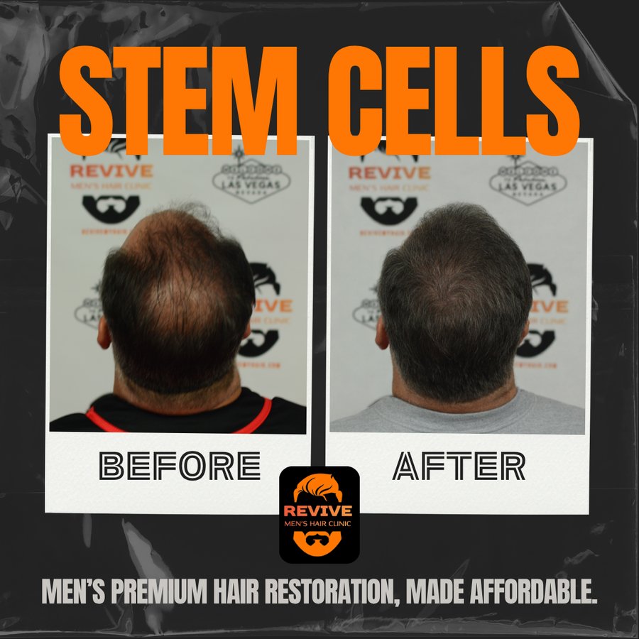 The Revive Protocol before and after, patient 6 of 12 — actual Revive Men’s Hair Clinic patient