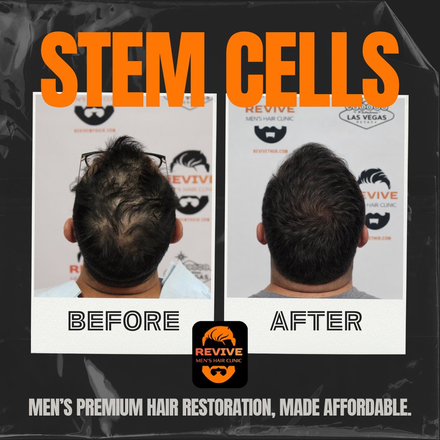 The Revive Protocol before and after, patient 7 of 12 — actual Revive Men’s Hair Clinic patient