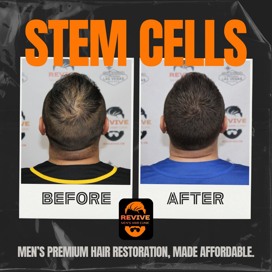 The Revive Protocol before and after, patient 8 of 12 — actual Revive Men’s Hair Clinic patient