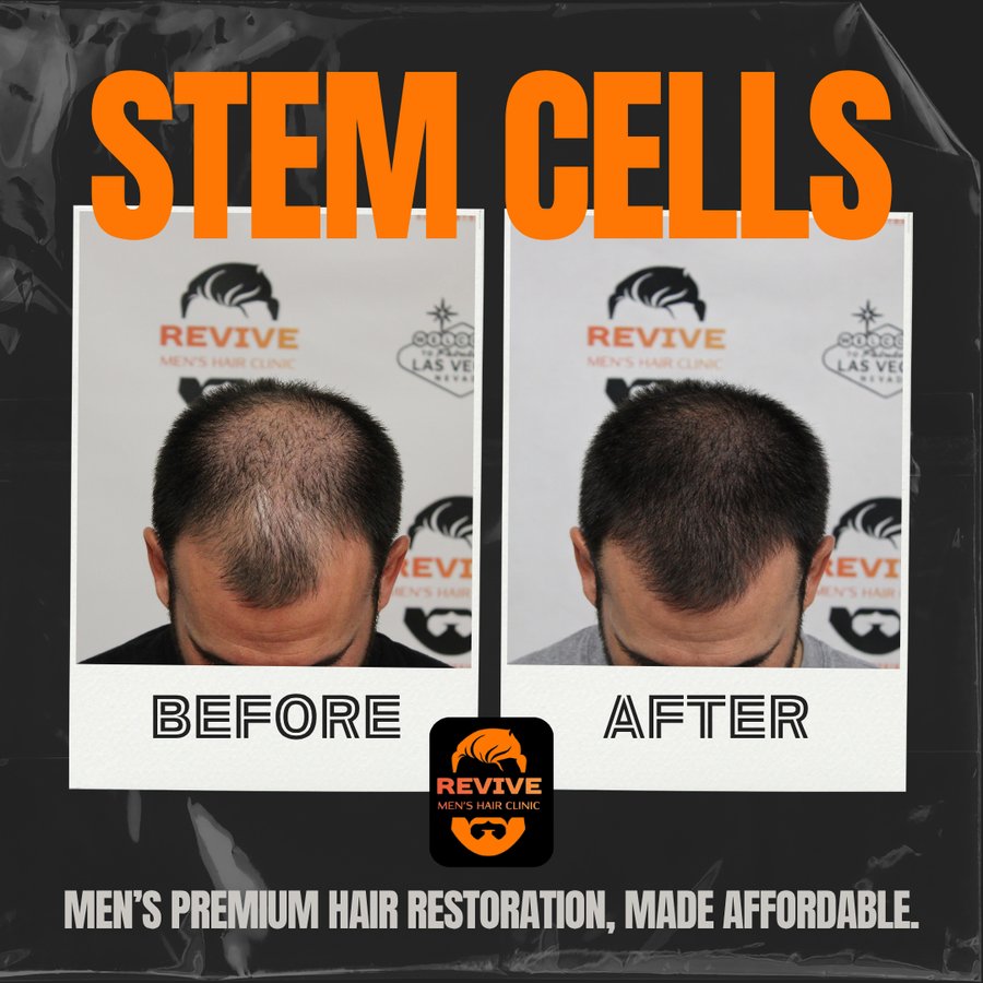 The Revive Protocol before and after, patient 9 of 12 — actual Revive Men’s Hair Clinic patient