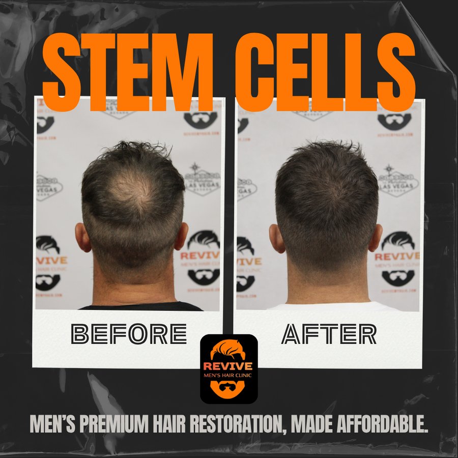 The Revive Protocol before and after, patient 10 of 12 — actual Revive Men’s Hair Clinic patient