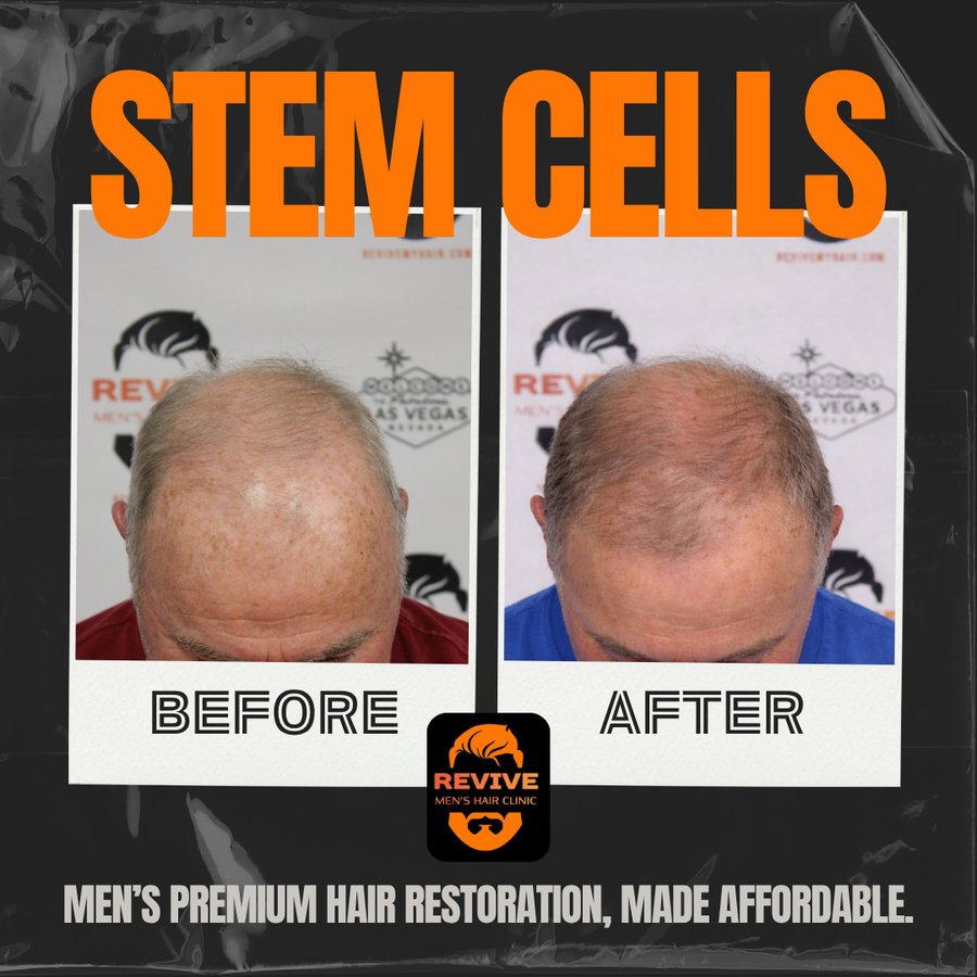The Revive Protocol before and after, patient 11 of 12 — actual Revive Men’s Hair Clinic patient