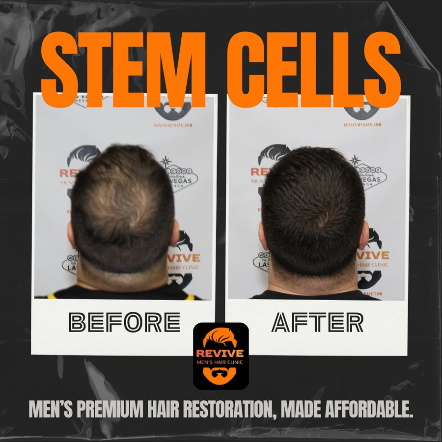 The Revive Protocol before and after, patient 12 of 12 — actual Revive Men’s Hair Clinic patient